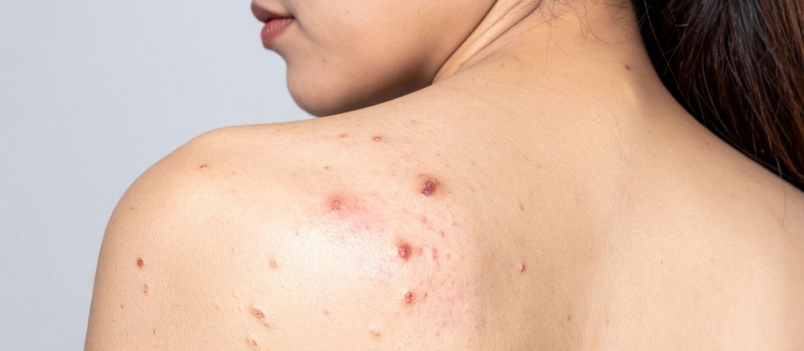 Body Acne vs Face Acne — Why They