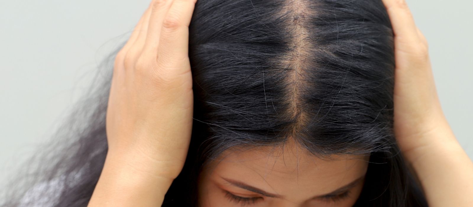 Why Is My Hair Thinning? Hormonal Hair Loss in Women Explained